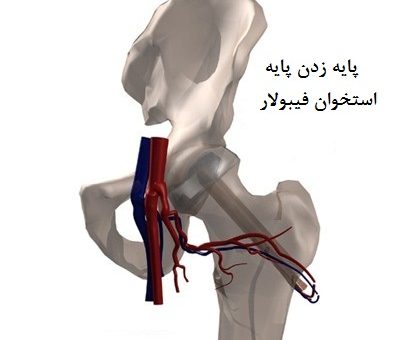 پیوند زدن استخوان فیبولار